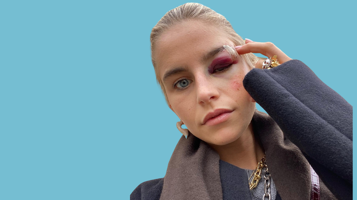 Caro Daur mit blauem Auge in Paris.